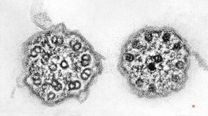 F,7y. | immotile cilia syndrome - nasal mucosa